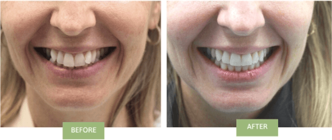 invisalign for crowded teeth before and after photos