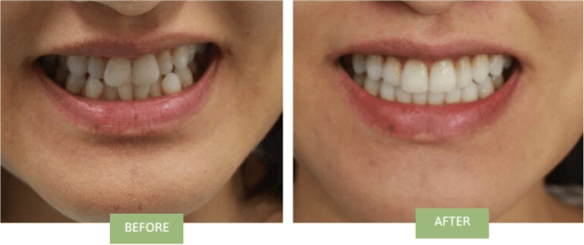 Invisalign near me for crowded teeth
