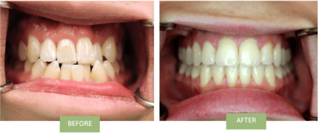 Best Invisalign treatment for Crowded teeth before & after in Manhattan 