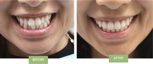 Invisalign for Crowded teeth before & after in Manhattan 
