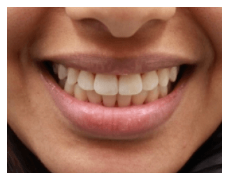front teeth realigned with Invisalign treatment 