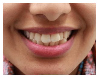 Can Invisalign fix crowding