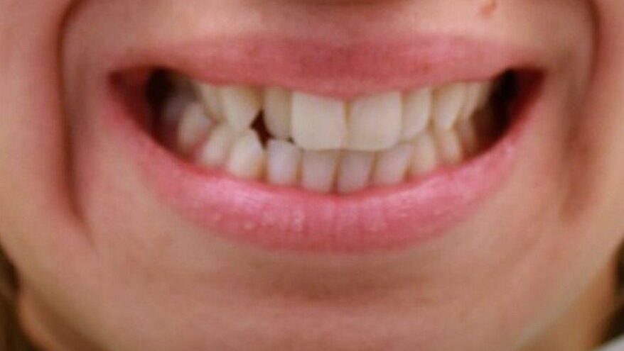 Crossbite before Invisalign 2