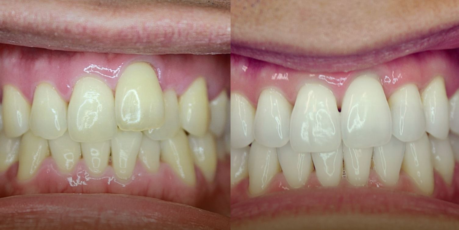 Dr Sang Ben Ahn Before After Invisalign
