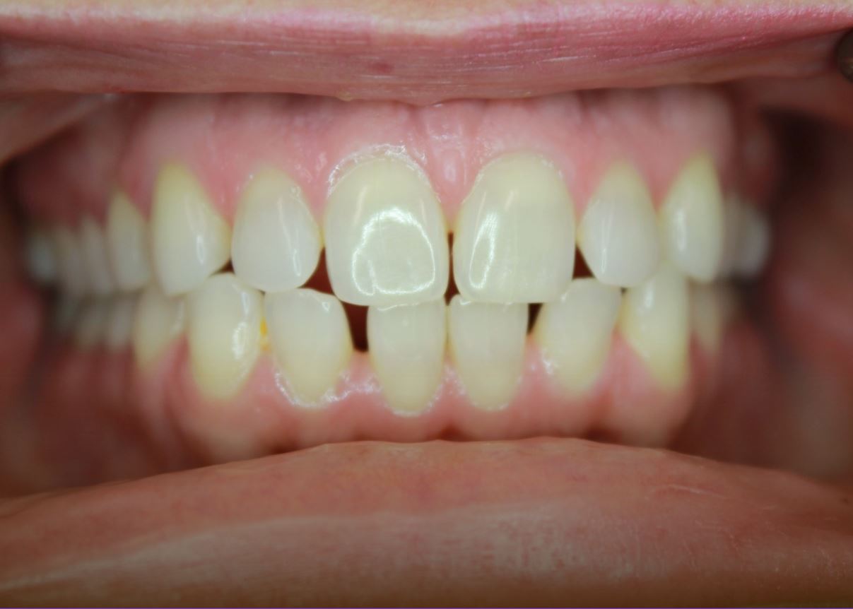 Gaps between teeth before Invisalign braces