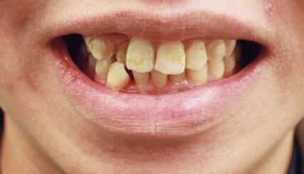 Anterior Crossbite