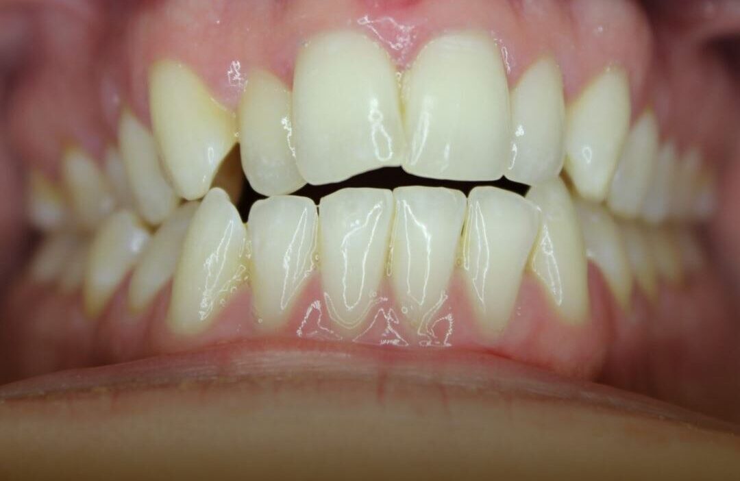 Open Bite before treatment with Invisalign