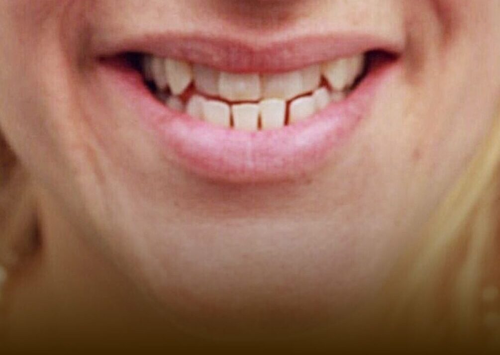 Underbite and gaps before Invisalign treatment