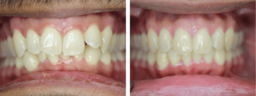 Invisalign For Crowding