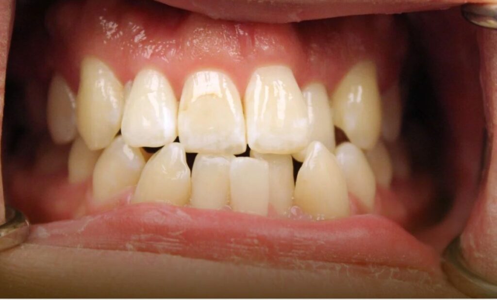 severe crowding before treatment with Invisalign