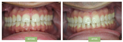 Front teeth gap
