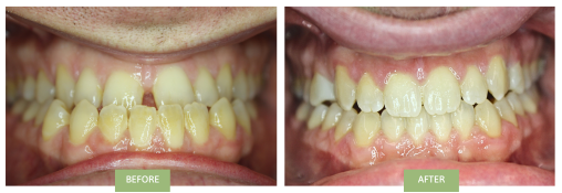 gaps between front teeth with sever underbite - before and after Invisalign treatment