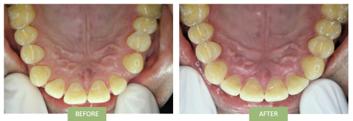 Top front teeth spacing fixed with Invisalign by Dr Benjamin Ahn