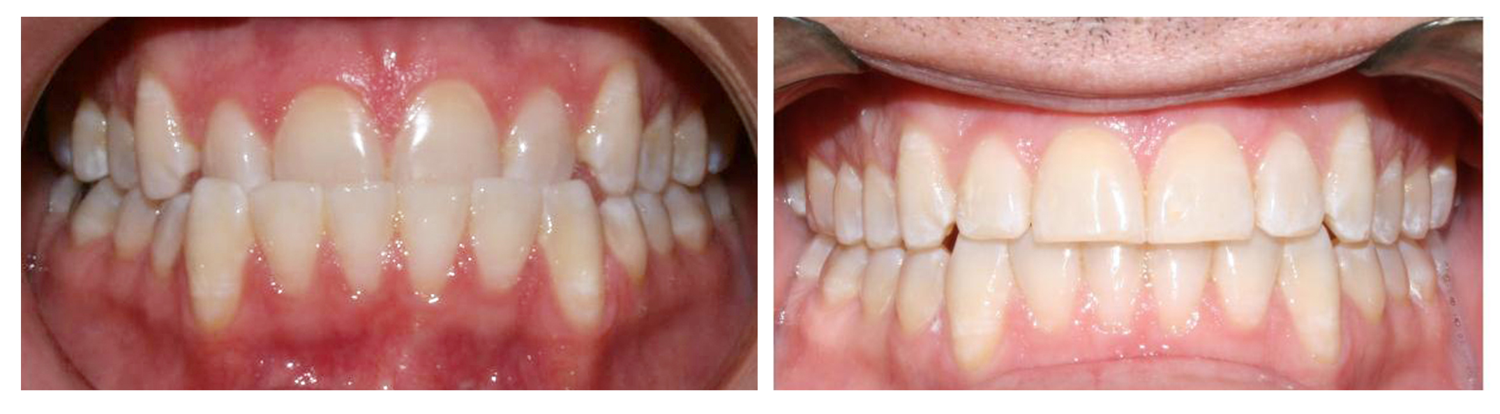 Crossbite correction in Manhattan, NY