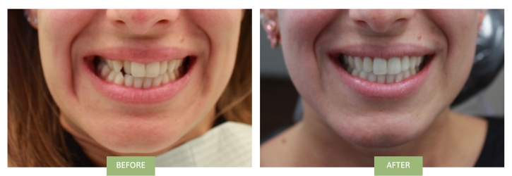 Crossbite - Before & After - Dr. Benjamin Ahn