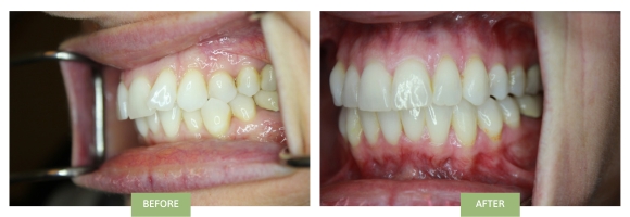 Anterior crowded teeth & crossbite