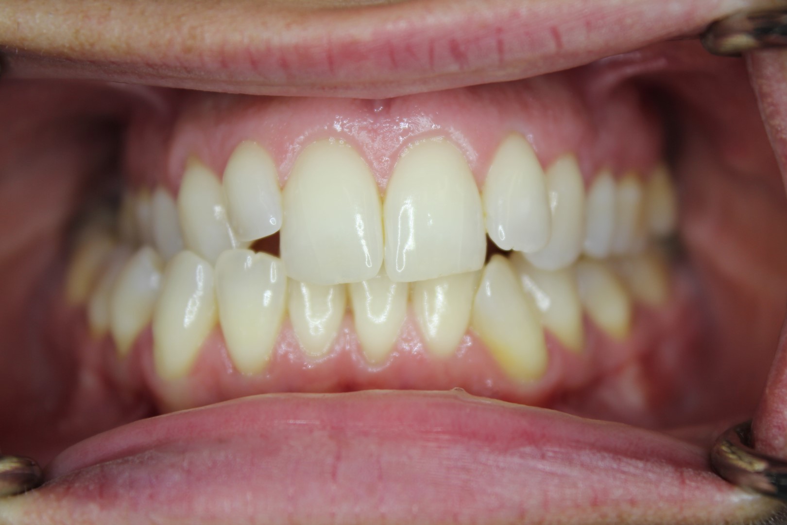 Crossbite Before