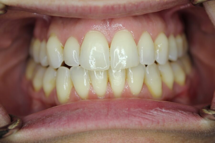 crossbite Invisalign after 
