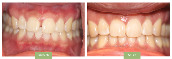A before-and-after image of Invisalign for gaps: upper front teeth treatment