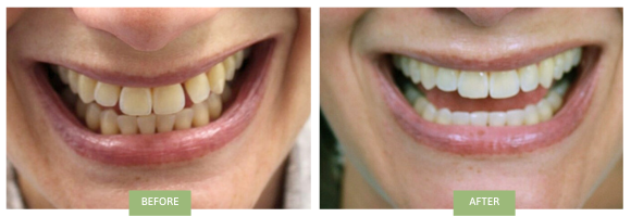 A before-and-after image of Invisalign for gaps: upper front teeth treatment