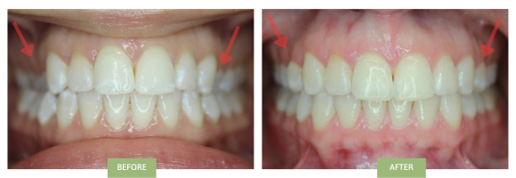 Buccal crossbite: severe posterior crossbites