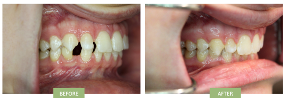 Invisalign for Gap Teeth Before & After