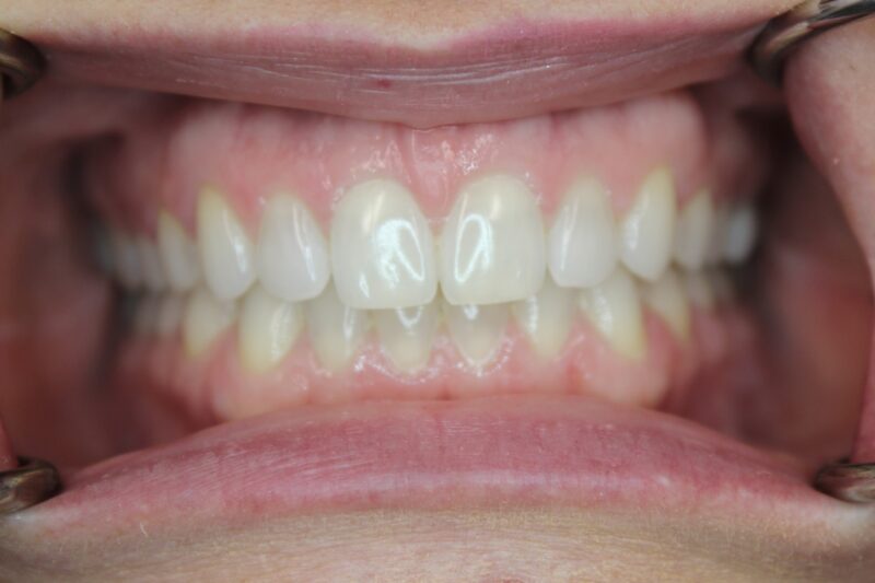 Invisalign for Gaps After photo