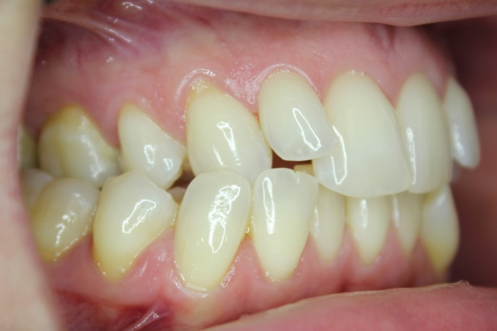 Posterior Buccal Crossbite