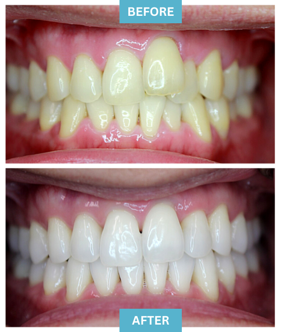 Teeth Crowding Before & After