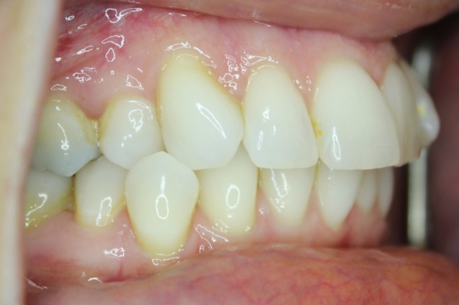 anterior crossbite